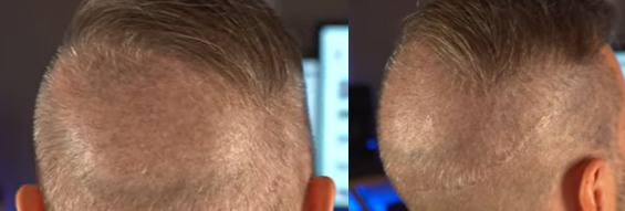 FUE hair transplant 3 weeks after surgery from different angles