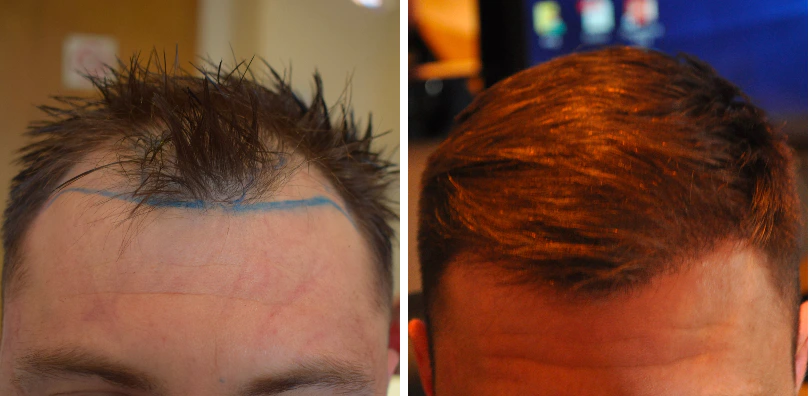 Hair transplant patient before and after hair transplant surgery at the Wimpole Clinic