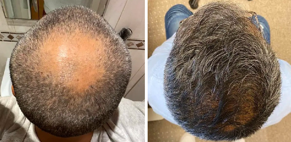 FUE hair transplant after 15 months