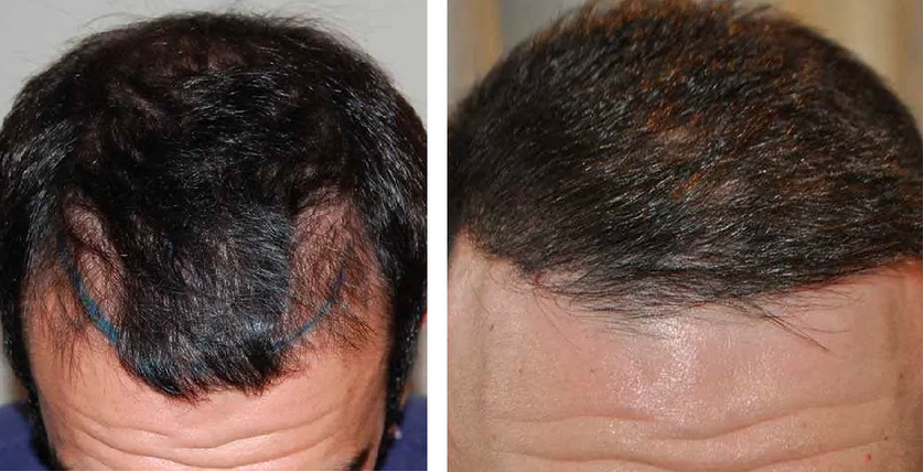 How To Get A Natural Looking Hair Transplant - Wimpole Clinic