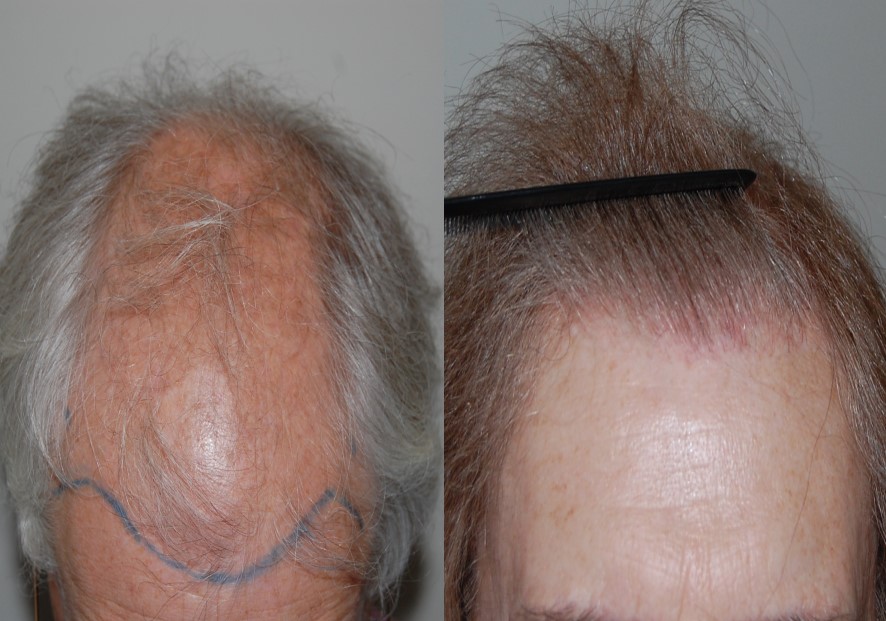 before and after FUT hair transplant