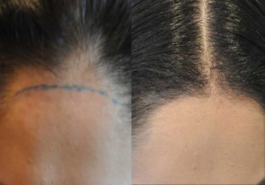 FUT-Female-Hair-Transplant
