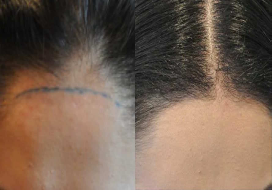 FUT female hair transplant