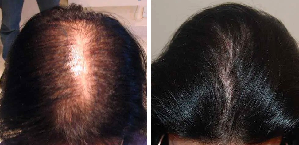FUT hair transplant after 12 months