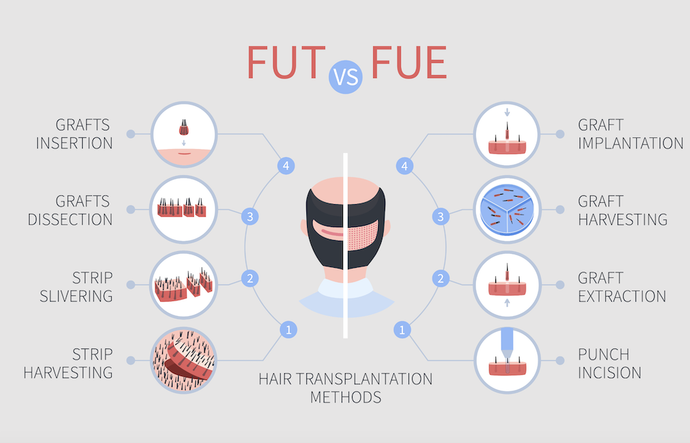 Informational graphic explaining how the transplanted hair is harvested and implanted in the FUE and FUT hair transplant processes