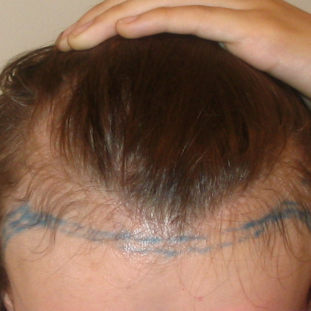 Example of a receding hairline in a woman