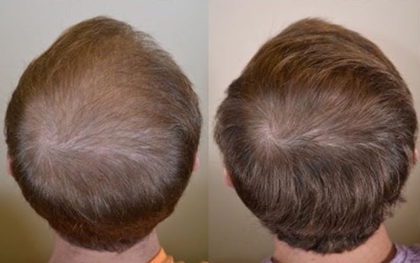 Before and after results of using Finasteride