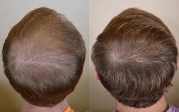 Before and after taking Finasteride to treat hair loss