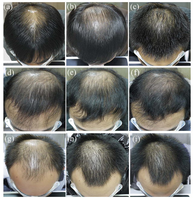 Minoxidil Combined With Finasteride: An Expert Review, Wimpole Clinic