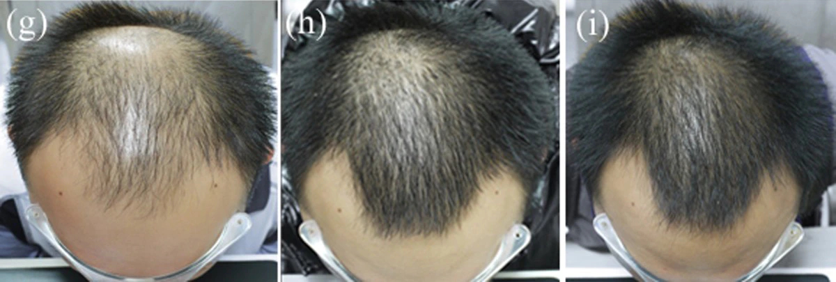 Hairline and mid-scalp restoration following a course of oral Finasteride combined with topical Minoxidil