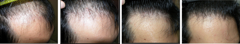Photos showing hairline restoration after taking 1mg Finasteride per day
