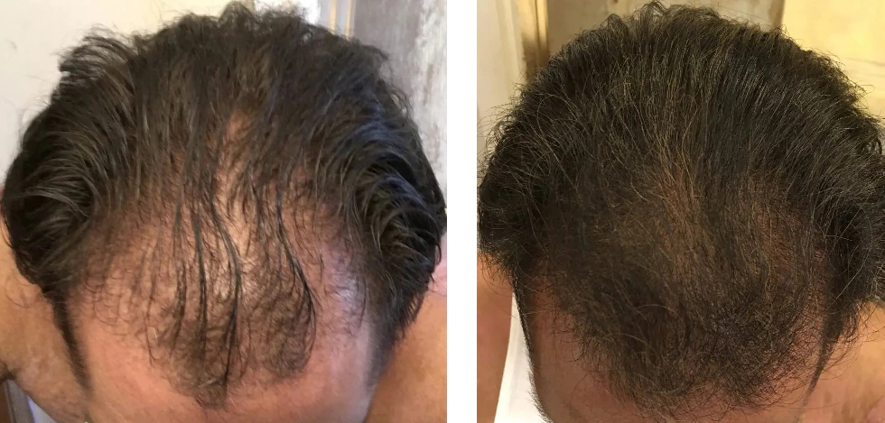 Finasteride results after 9 months of use