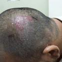 Folliculitis After Hair Transplant: Causes, Symptoms, Treatments