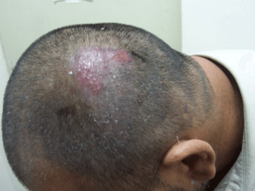 folliculitis scalp