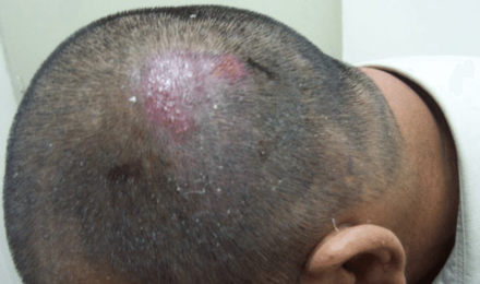 Folliculitis After Hair Transplant Featured Image