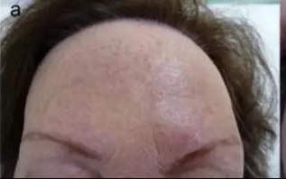Example of Frontal fibrosing alopecia