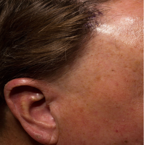 Frontal Fibrosing Alopecia: Causes, Symptoms &#038; Treatments, Wimpole Clinic