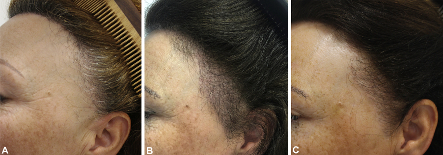 Frontal Fibrosing Alopecia  disguising the effects  Lucinda Ellery LA and  NYC