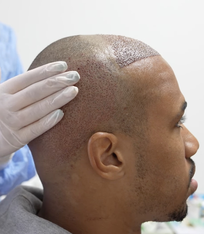 Gabriel Magalhães Hair Transplant Everything You Need To Know