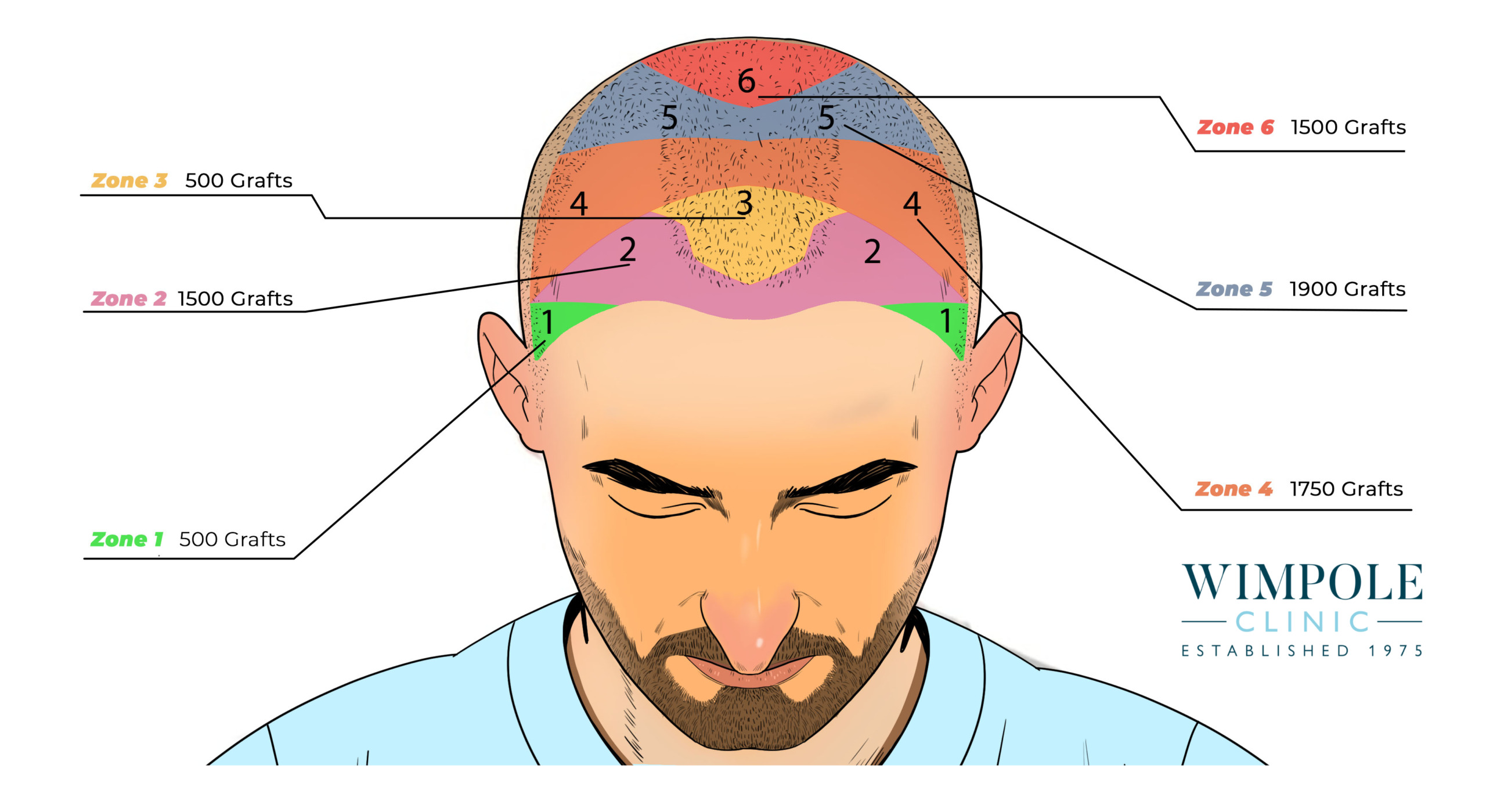 Information graphic showing how many grafts are needed to restore hair.