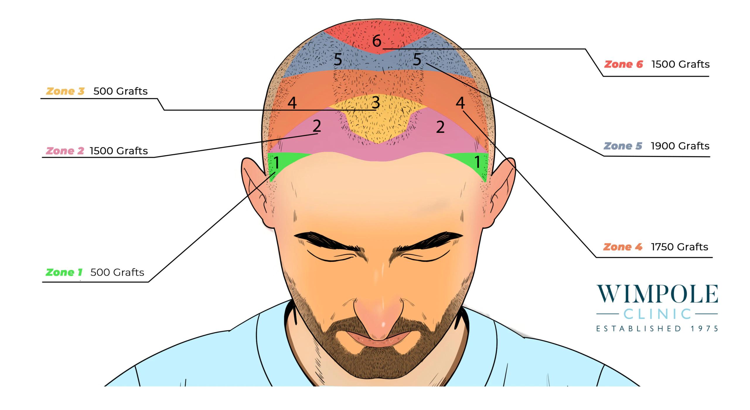 Wimpole Clinic informational graphic depicting how many hair grafts are needed for hair restoration