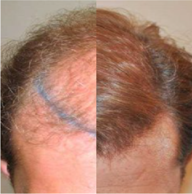 FUT Hair Transplant, Wimpole Clinic