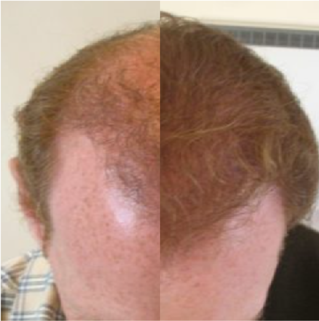 FUT Hair Transplant, Wimpole Clinic