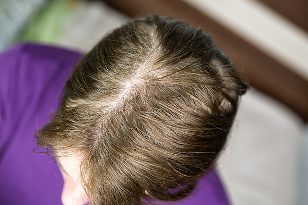 Does Low Testosterone Cause Hair Loss? Signs, Symptoms and Treatment, Wimpole Clinic