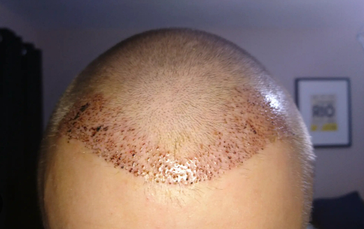 Hairline Transplant After 7 Days