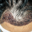 Hair Transplant Infection: Everything You Need To Know