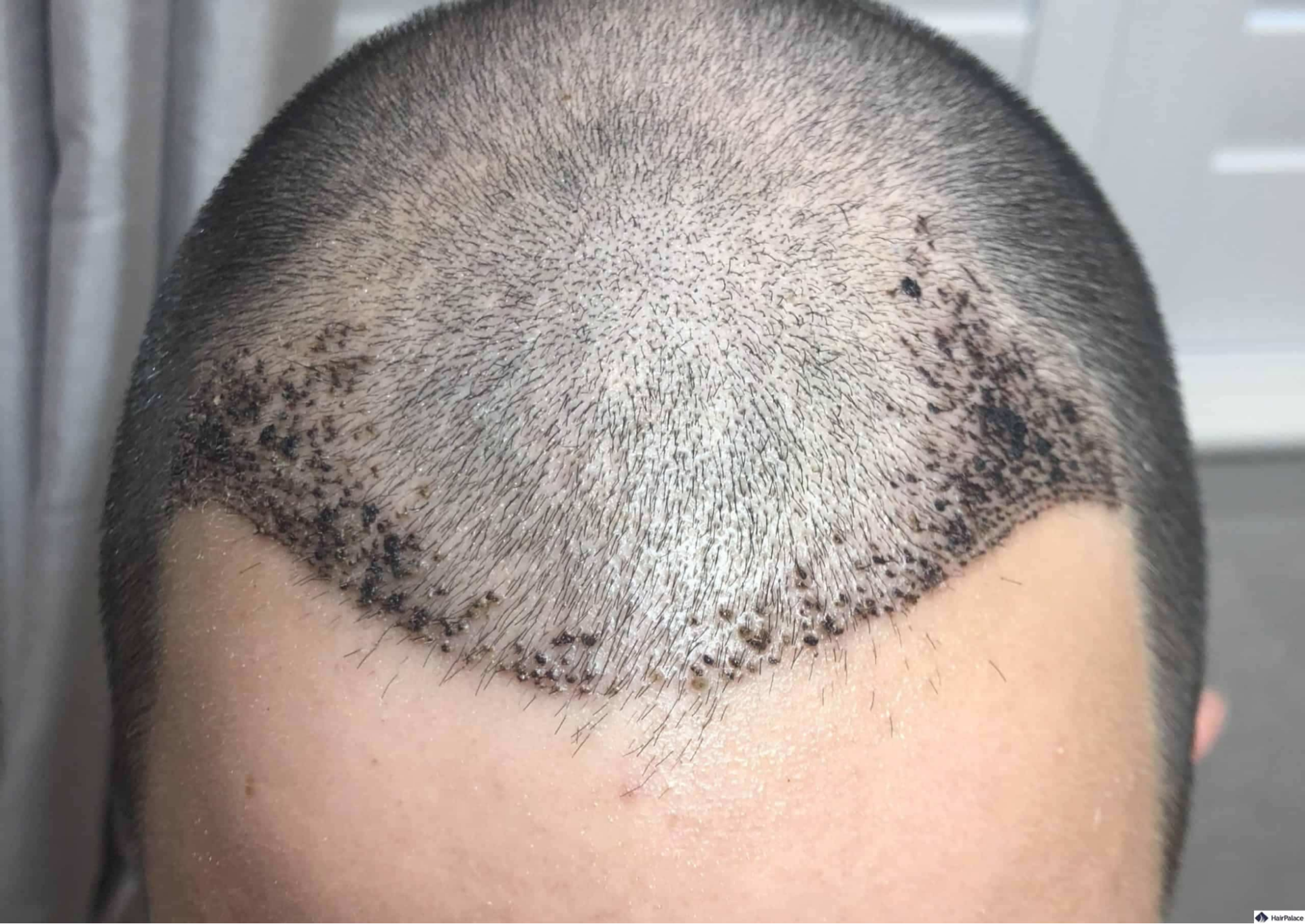 Scabs 7 days after a hair transplant