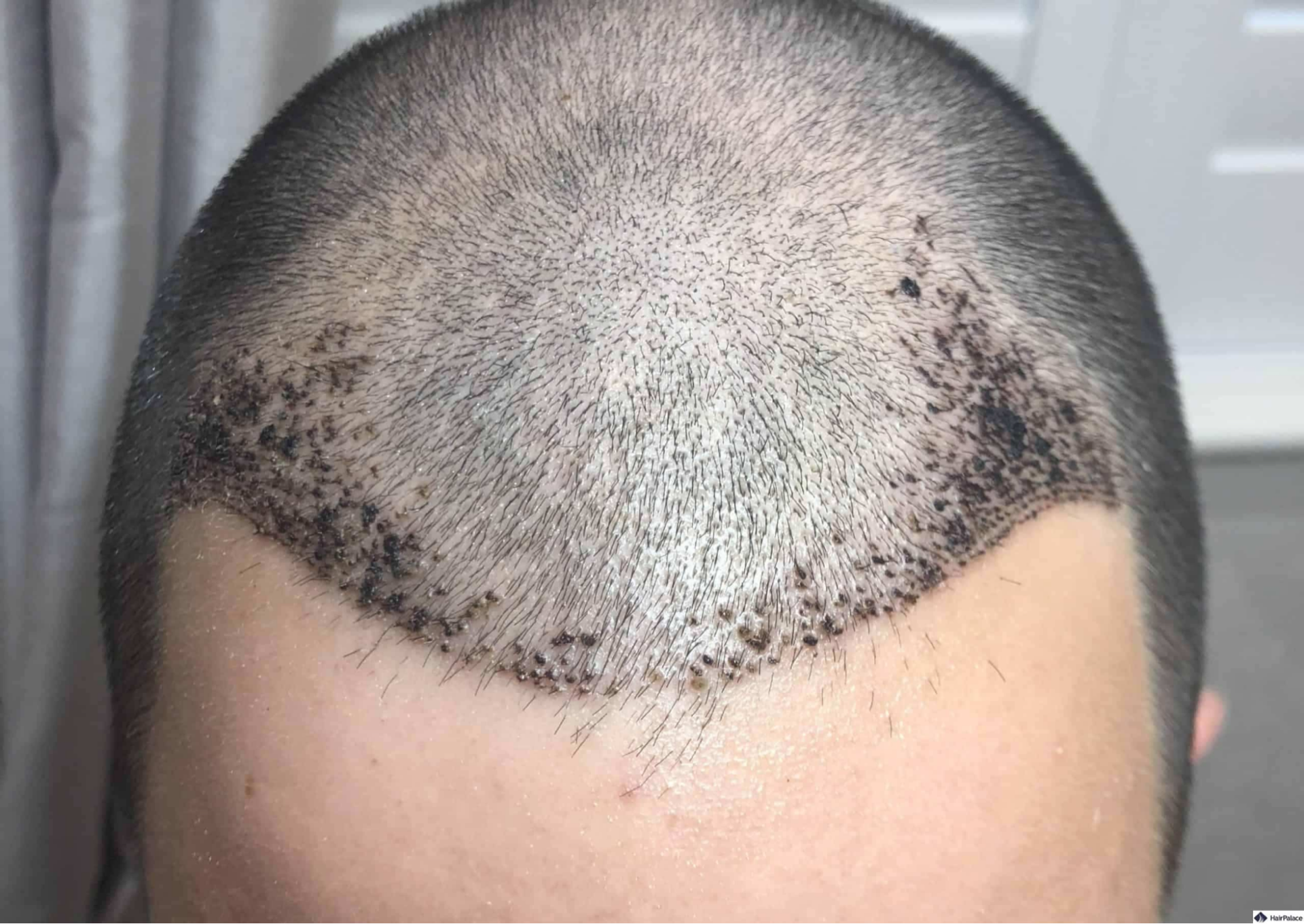 Hair Transplant After 7 Days: Photos, Results & Aftercare