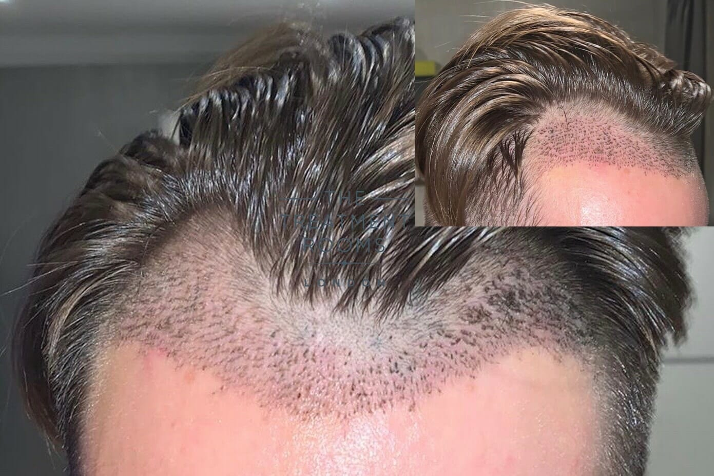 Scaps following a hairline transplant, working slighlty into the mid scalp after 7 days