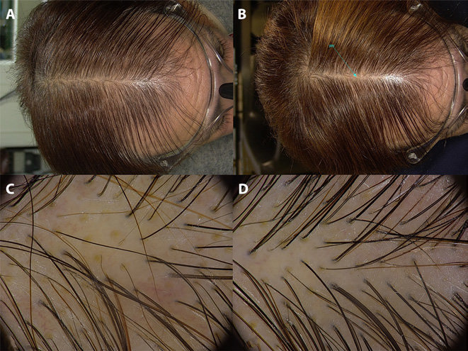 Hair density at baseline and after 6 months of Finasteride use