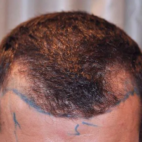 How To Fix A Messed Up Hairline, Wimpole Clinic