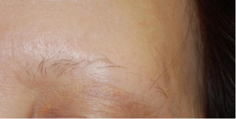 Frontal Fibrosing Alopecia: Causes, Symptoms &#038; Treatments, Wimpole Clinic