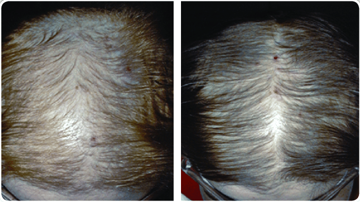 Before and after hair growth results from oral Finasteride treatment in female patient