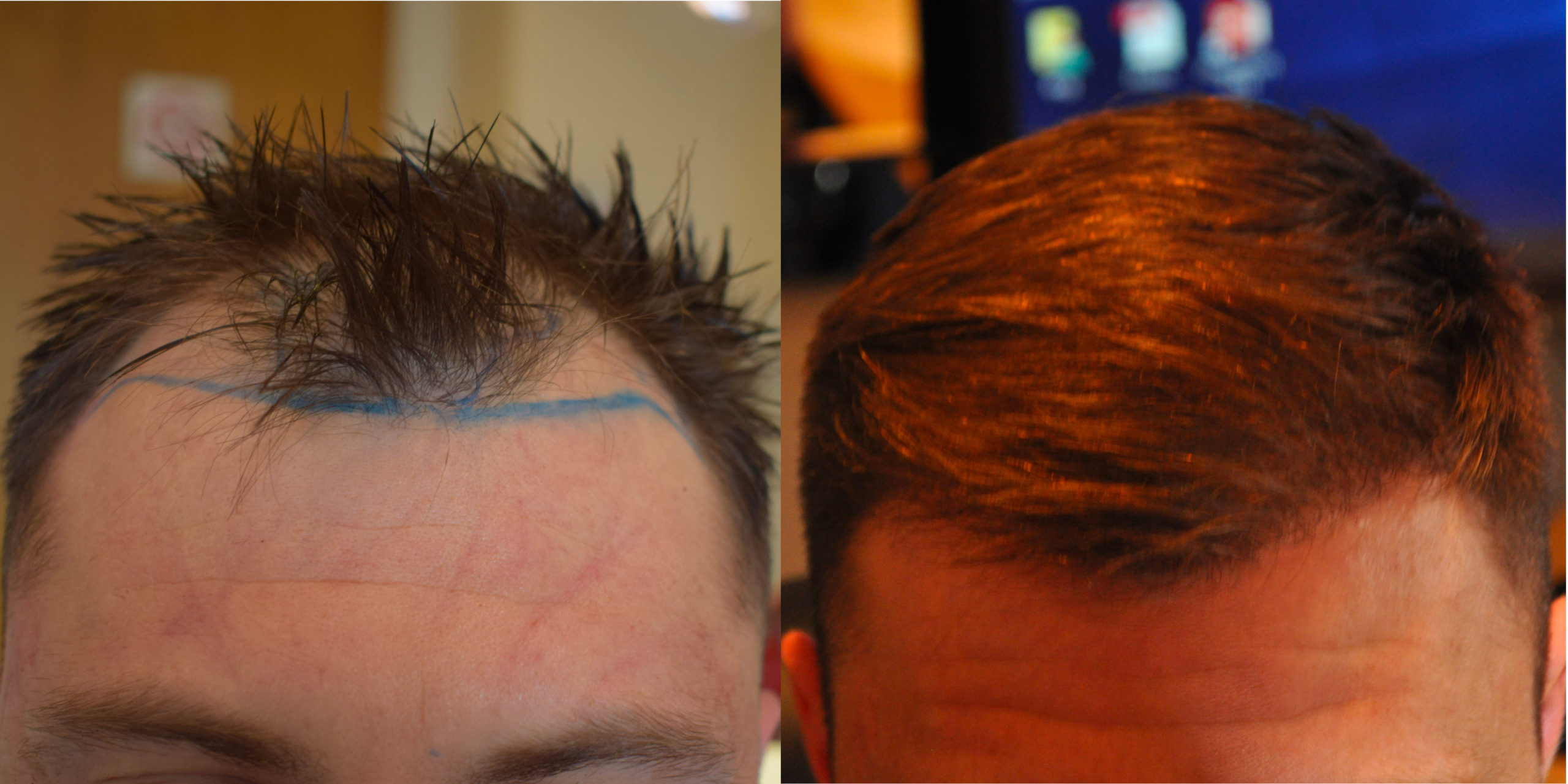 Which factors can convince you to take hair transplant treatment from us