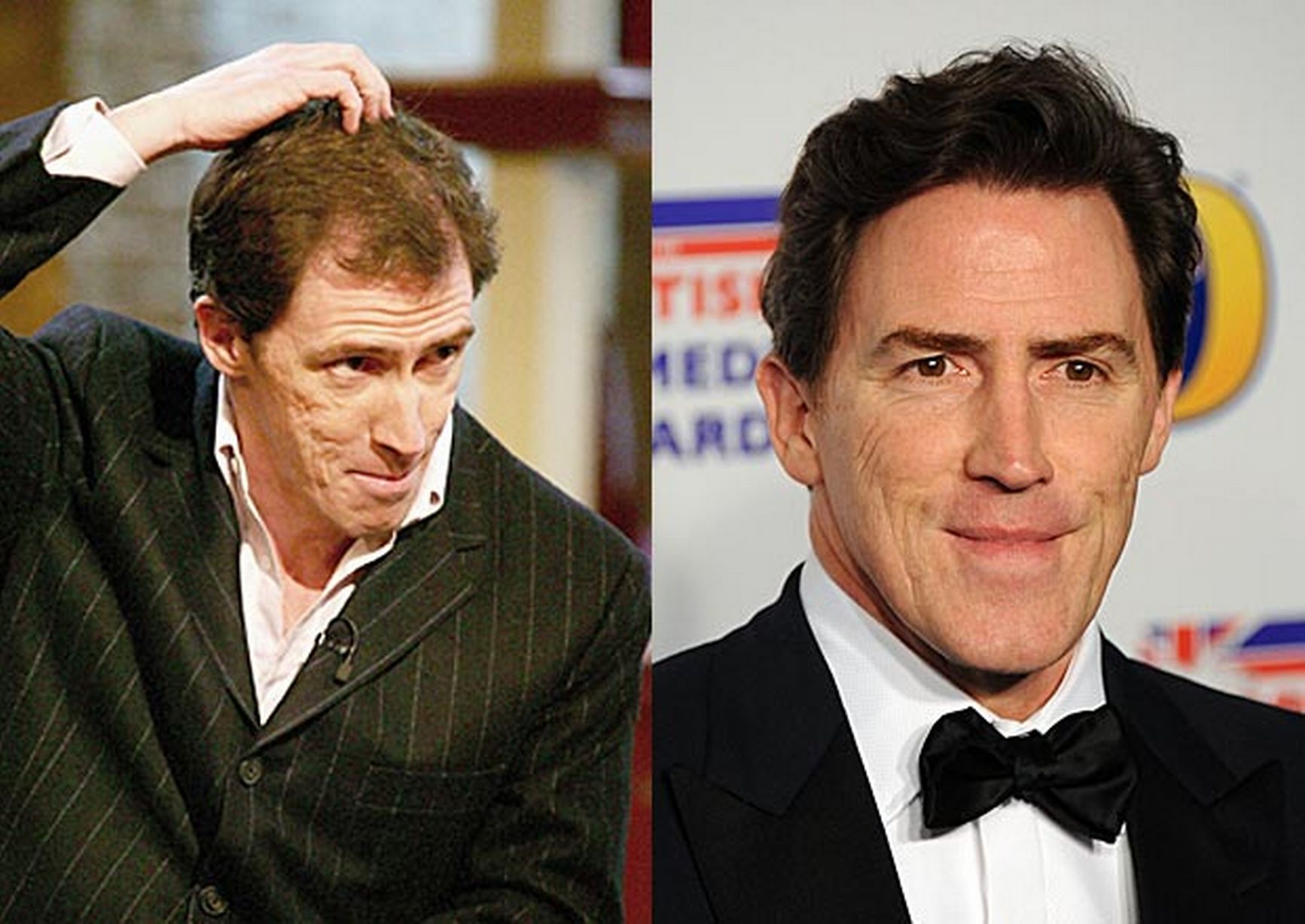 Rob Brydon before and after rumoured hair transplant