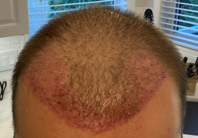 Hairline and temples transplant after 3 weeks