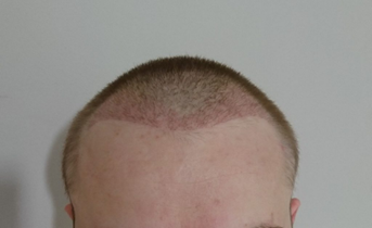 Hairline and temples transplant after 3 weeks