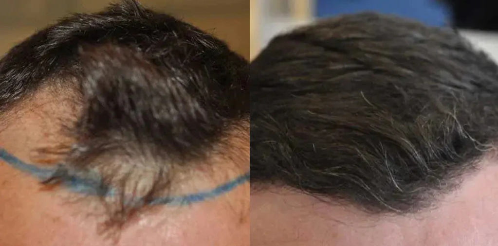 patient's hairline before and after hair transplant surgery