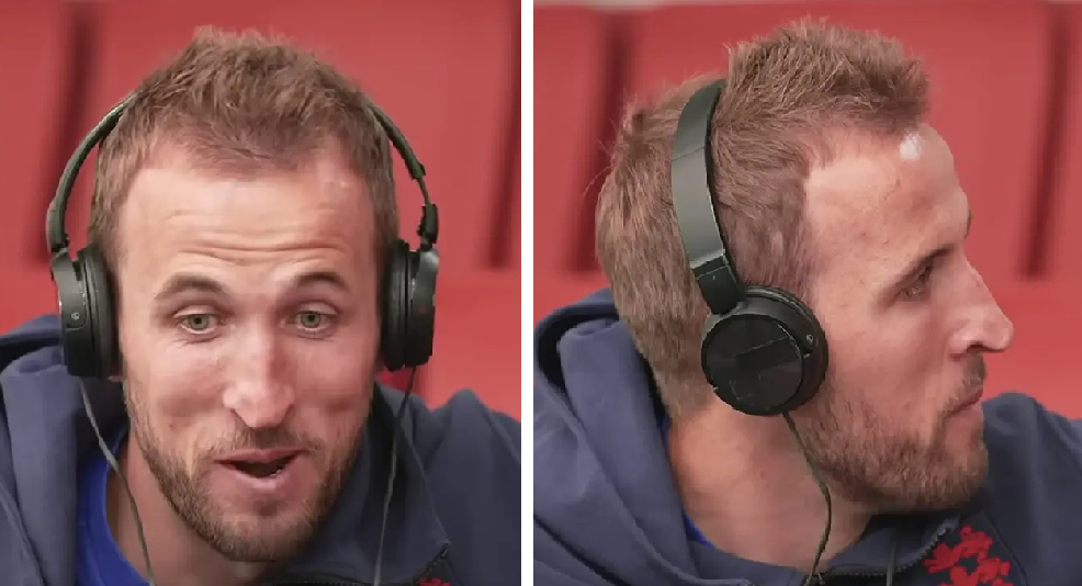 Harry Kane's hairline in 2022 with increased hair density at the temples