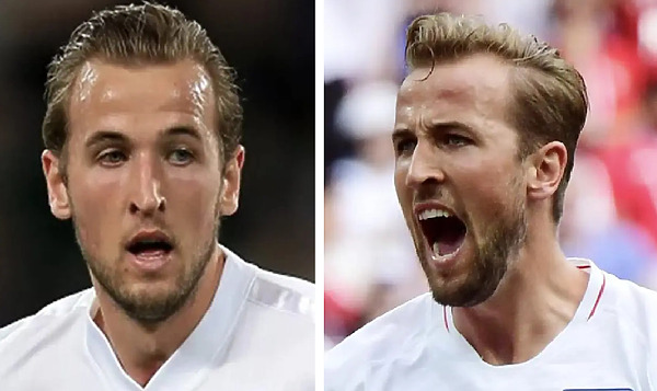 Harry Kane Hair Transplant: Everything You Need To Know