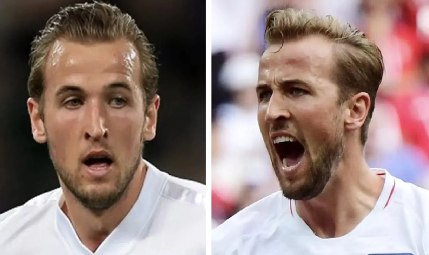 Harry Kane Hair Transplant: Everything You Need To Know