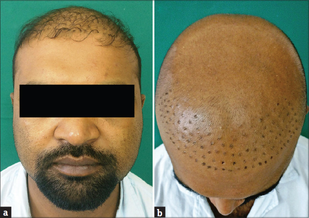 Hair transplant patient with hair plugs, an outdated form of hair transplantation