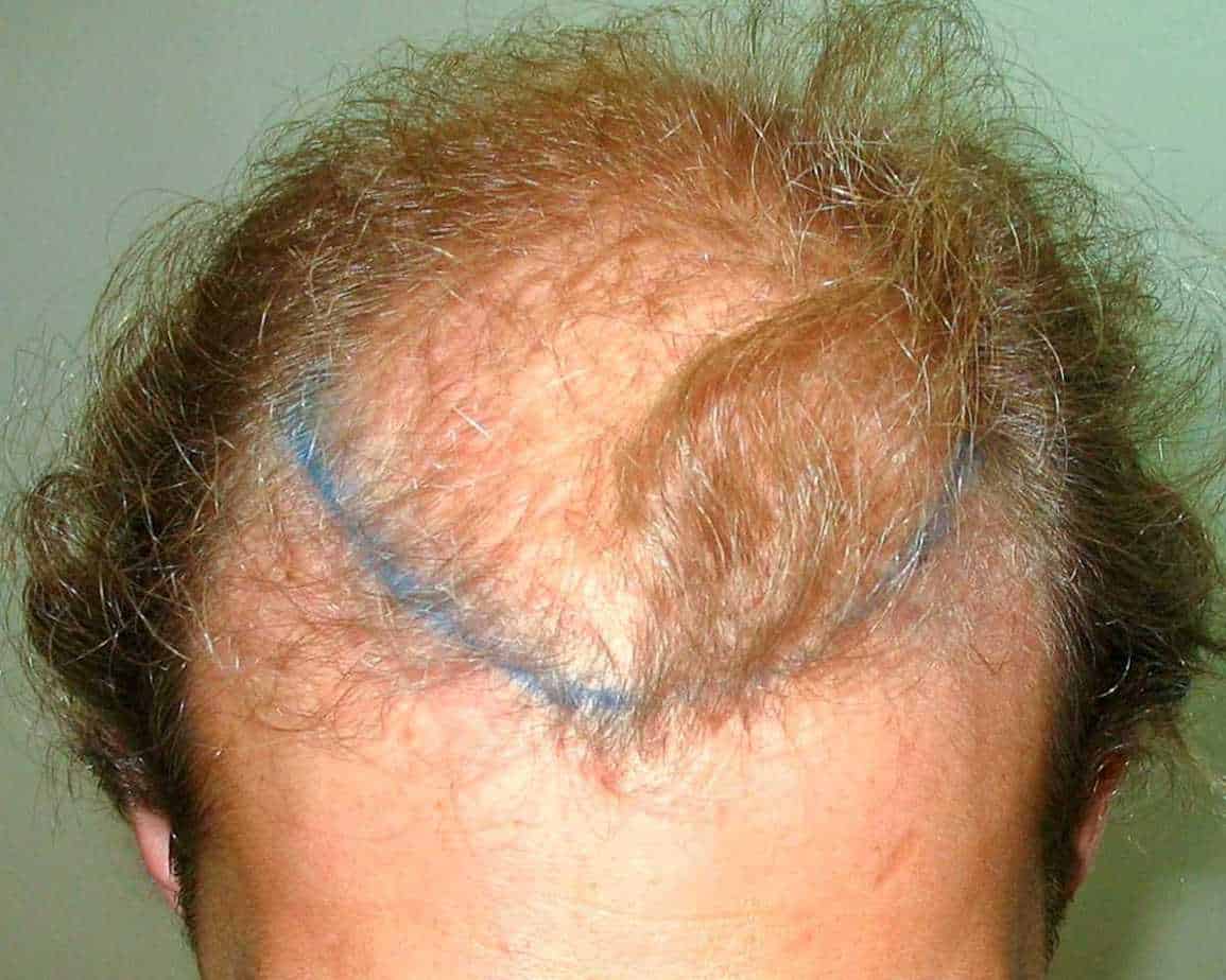 FUT Hair Transplants: Facts, Costs &#038; Results, Wimpole Clinic