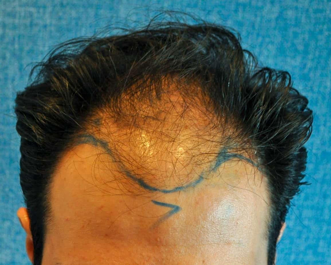 How Many Hair Grafts Do I Need? | Wimpole Clinic