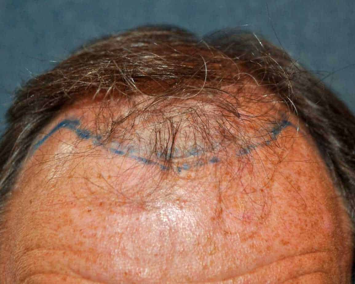 Hair Transplant Falling Out After 1 Year: What To Do Next, Wimpole Clinic