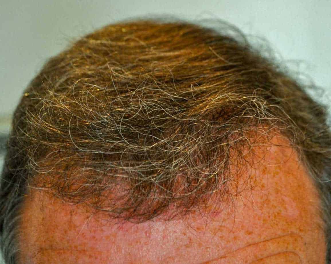 Hair Transplant Falling Out After 1 Year: What To Do Next, Wimpole Clinic